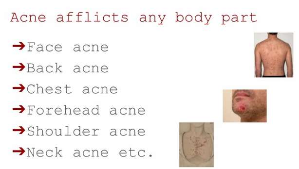 Acne afflicts any body part